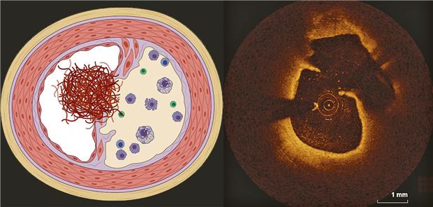 ACS ist nicht gleich ACS – die Immunologie unterscheidet sich ACS durch Plaque mit rupturierter Kappe (RFC-ACS).