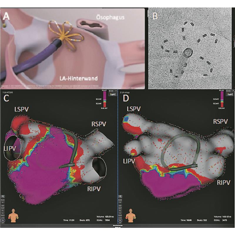 PulsedFieldAblation neue Chancen, neue Risiken?