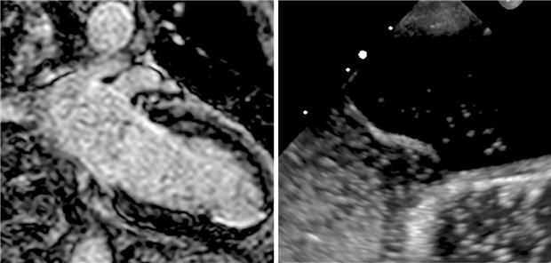 Abb. 1-- Fallbeispiel mit Kardio-MRT (links) und TEE mit Nachweis eines PFO (Übertritt von „Bubbles“; rechts). Die zugehörigen Brustwandableitungen waren unauffällig, die Extremitätenableitungen zeigen auffällige QRS-Komplexe.