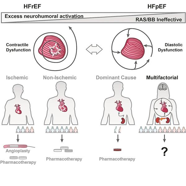 DFG-Sonderforschung zur Herzinsuffizienz Abb. 1-- HFrEF: Linksventrikuläre Dilatation und eine kontraktile Dysfunktion führen zu einer übermäßigen neurohumoralen Aktivierung. Dies lässt sich durch Medikamente, dieauf das Renin-Angiotensin-Aldosteron-System (RAAS), das sympathische Nervensystem und das Neprilysin-System wirken, erfolgreich behandeln. HFpEF: Nur eine kleine Untergruppe von HFpEF-Patienten hat eine primäre dominante Ursache, die durch eine spezifische Therapie behandelt werden kann. Die große Mehrheit der HFpEF manifestiert sichals sekundäre Erkrankung und ist durch ein multifaktorielles Risiko begründet. In der EUleiden 6 Millionen Patienten an HFpEF, für die es keine ausreichende Therapie gibt.1 Torso entspricht ca. 500.000 Patientinnen (rosa) und Patienten (blau).