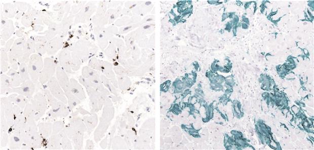 Inflammation bei kardialer Amyloidose Abb. 1-- Kardiale TTR-Amyloidose: Immunhistochemischer Nachweis einer Infiltration inflammatorischer CD3+-T-Lymphozyten bei einer kardialen Beteiligung einer Transthyretin-Amyloidose (ATTR) eines 70-jährigen männlichen Patienten. Prof. Karin Klingel