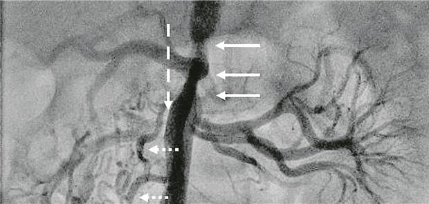 Abb. 1-- (PA); kurzstreckige Hypoplasie der abdominellen Aorta beginnend oberhalb des Truncus coeliacus bis zum Abgang der Nierenarterien (durchgehende Pfeile); Nierenarterienstenose rechts (gestrichelter Pfeil) mit zahlreichen Kollateralen (gepunktete Pfeile); krankheitstypisch: multiple arterielle Nierenversorgung (links).