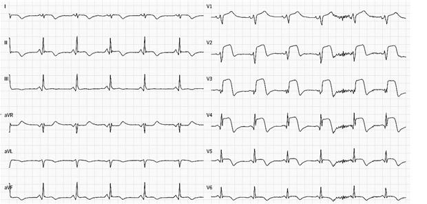 Abb. 1-- Ruhe-EKG in der Notaufnahme mit anterioren ST-Hebungen. Meyer-Zürn