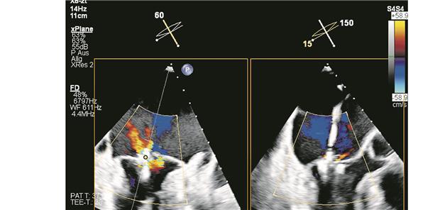 Das interventionelle Trio Abb. 1c-- Echokardiografische Darstellung einer MI vor (li), während (Mitte) und nach (re) der Intervention mit einem PASCAL-System.
