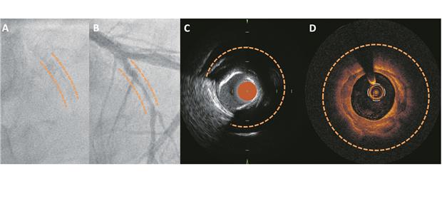 Treat the rock – Kalk als Challenge Abb. 2-- Fallbeispiele von schweren Koronarkalzifizierungen in der Koronarangiografie ohne (A) und mit Kontrastmittel (B), im intravaskulären Ultraschall (C) und in der optischen Kohärenztomografie (D). Die verkalkten Abschnitte sind mit orangenen Linien markiert.