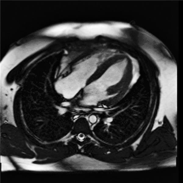 Septische Kardiomyopathie oder Kounis-Syndrom? That is the question! Abb. 2-- MR-Darstellung des Herzens ohne Nachweis eines Late Gadolinium Enhancement als Hinweis auf eine Myokarditis oder eines Nachweises anderer myokardialer Pathologien.