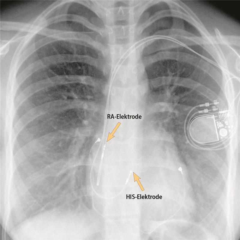 Conduction System Pacing – hot or not?