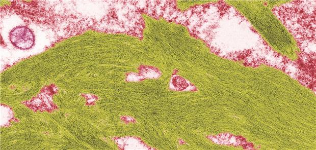 Amyloidose-- Farbige Elektronenmikroskopie eines Gewebeschnitts mit abnormen Amyloid-Ablagerungen (grün). Steve Gschmeissner/Science Photo Library