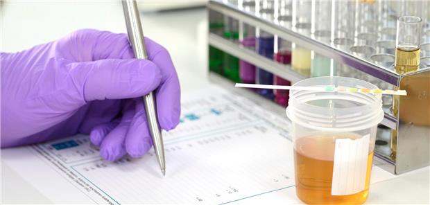 Analyse: SGLT2-Hemmer lösen Ketoazidosen auch ohne Diabetes aus Urinprobe eines Patienten der SGLT2-Hemmer einnimmt wird im Labor auf eine SGLT2i-assoziierte Ketoazidose untersucht.