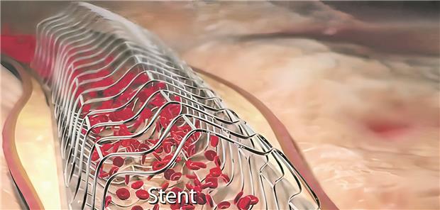 Unsere Vorstellungen werden erneut herausgefordert Eine Stentimplantation soll die Perfusion des Myokards verbessern – ein allgemein akzeptiertes Konzept.