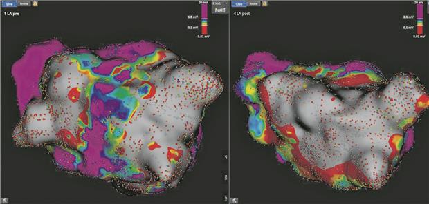 PFA als zusätzliche Therapieoption High Density-3-D-Voltage Mapping (Orion-Kathetermapping, Rhythmia®, Boston Scientific) des posterioren linken Vorhofs vor (links) und nach (Mitte) PFA-Behandlungmit einem 35-mm-PentaSpline-Katheter; die violette Farbe zeigt bipolare Elektrogramme mit 0,5mV. Rechts oben ist der PentaSpline-Katheter (FaraWave®, FaraPulse®, Boston Scientific) bei Ablation an der posterioren linksatrialen Wand zu sehen sowie am rechten Bildrand zwei Devices nach erfolgreicher TEER.