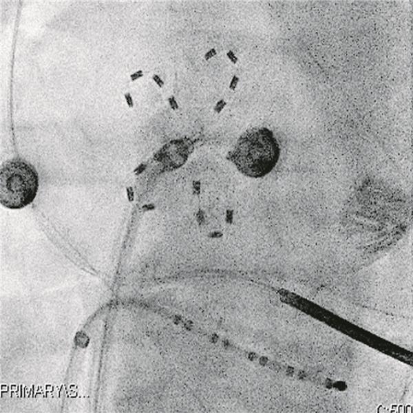 PFA als zusätzliche Therapieoption High Density-3-D-Voltage Mapping (Orion-Kathetermapping, Rhythmia®, Boston Scientific) des posterioren linken Vorhofs vor (links) und nach (Mitte) PFA-Behandlungmit einem 35-mm-PentaSpline-Katheter; die violette Farbe zeigt bipolare Elektrogramme mit 0,5mV. Rechts oben ist der PentaSpline-Katheter (FaraWave®, FaraPulse®, Boston Scientific) bei Ablation an der posterioren linksatrialen Wand zu sehen sowie am rechten Bildrand zwei Devices nach erfolgreicher TEER.