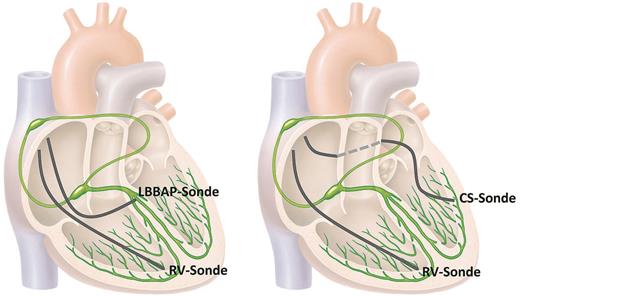 Implantationsstrategie-- LBBAP (links) und CRT (rechts). [M] lom123/stock.adobe.com