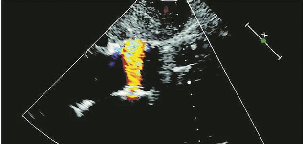 Interatriale Shunts: tot oder lebendig? Interatriales Shunt-Device-- Schema des interatrialen Shunts, der eine Verbindung zwischen dem linken und dem rechten Vorhof ermöglicht (links), und Echokardiografie mit Doppler-Farbfluss vom linken zum rechten Vorhof (rechts).