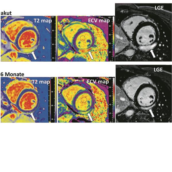 Myokarditis: Zunehmende Bedeutung der kardialen MRT Kardiale Magnetresonanztomografie (Abb. 1)-- Exemplarische CMR-Bilder (LGE-, T1- und T2-Mapping) eines jungen Sportlers mit COVID-assoziierter Myokarditis zum Zeitpunkt der Diagnosestellung und nach 6 Monaten. Beachten Sie posterolateral die Abnahme des entzündlichen Ödems (Pfeil, T2 map), sowie die Schrumpfung der entzündlichen Narbe im Verlauf (Pfeile, ECV map und LGE).modifiziert aus Dtsch Z Sportmed. 2023;74:19-23