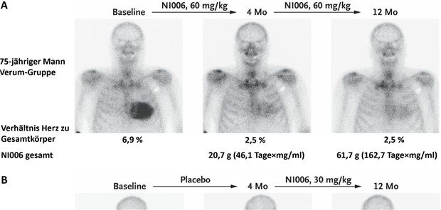 Knochen-Szintigrafie undMRT zeigen Amyloidlast nach„Depleter“-Behandlung (Abb. 1)-- Serielle Szintigrafien (A, B) und mittels T1-Mapping ermitteltes extrazelluläres Volumen in der kardialen MRT (C, D) nach 4 Monaten verblindeter Studienphase und weiteren 8 Monaten Open-label-Phase. In der Verum-Gruppe nahm die Amyloidlast ab, wohingegen in der Placebo-Gruppe keine positiven Veränderungen nachweisbar waren. Nach Wechsel in die Verum-Gruppe nach 4 Monaten zeigten sich 12 Monate nach Studienbeginn bei beiden Patienten Veränderungen.mit freundl. Genehmigung aus [6]Garcia-Pavia P et al. N Engl J Med. 2023;389(3):239-50