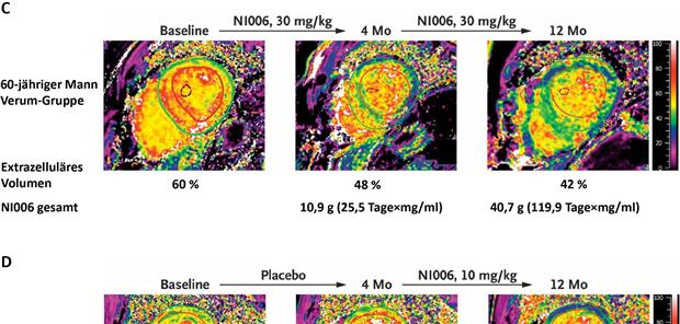 Knochen-Szintigrafie undMRT zeigen Amyloidlast nach„Depleter“-Behandlung (Abb. 1)--Serielle Szintigrafien (A, B) und mittels T1-Mapping ermitteltes extrazelluläres Volumen in der kardialen MRT (C, D) nach 4 Monaten verblindeter Studienphase und weiteren 8 Monaten Open-label-Phase. In der Verum-Gruppe nahm die Amyloidlast ab, wohingegen in der Placebo-Gruppe keine positiven Veränderungen nachweisbar waren. Nach Wechsel in die Verum-Gruppe nach 4 Monaten zeigten sich 12 Monate nach Studienbeginn bei beiden Patienten Veränderungen.mit freundl. Genehmigung aus [6] Garcia-Pavia P et al. N Engl J Med. 2023;389(3):239-50