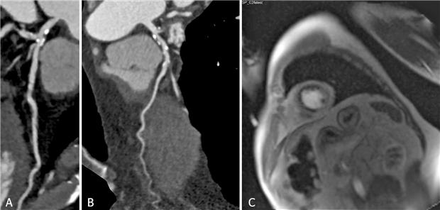 Nicht invasive und invasive Bildgebung bei koronarer Herzerkrankung-- A) Moderate LAD-Stenose. Verkalkungen im Hauptstamm (Kardio- CT), B) Hochgradige proximale LAD-Stenose mit sklerosiertem Hauptstamm (Kardio-CT), C) Ischämie der mittleren Wandabschnitte (Kardiale Stress-MRT mit Adenosin).