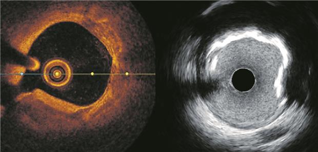 Muss der Aufwand immer sein? OCT und IVUS liefern detaillierte Informationen über lumennahe Strukturen, aber auch über die Struktur der Gefäßwand – hier zu sehen eine Kalkplaque.