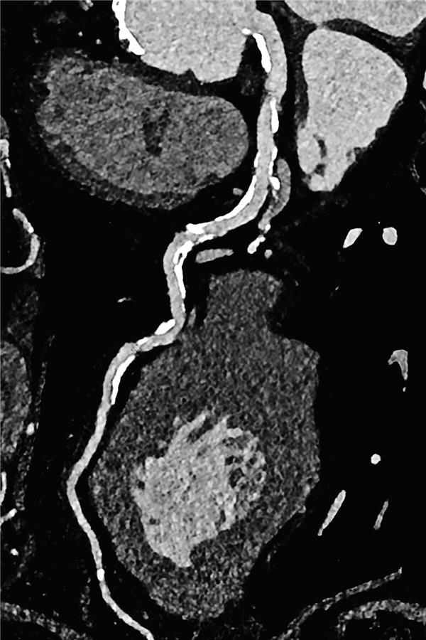 Nicht invasive Diagnostik für Hochrisikopatienten Photon-Counting-CT-Aufnahme die zeigt, dass die Gefäße nicht verstopft sind.