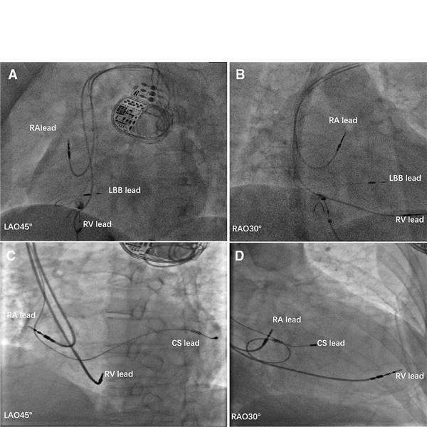 Repräsentative Bilder der Sonden von LBBAP (A, B) und BiVP (C, D). Juan Hua [5]