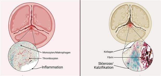 Schnell voranschreitende AS Schnell voranschreitende Aortenklappenstenose (links) – Langsam voranschreitende Aortenklappenstenose (rechts)-- Unterschiede zwischen der schnell und der langsam voranschreitenden Aortenklappenstenose. Harm/Müller