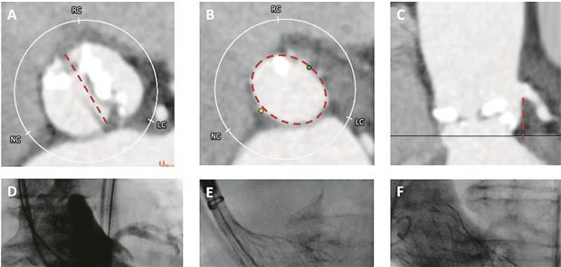 TAVI bei hochgradiger Stenose der Aortenklappe-- 82-jährige Patientin mit hochgradiger dekompensierter Aortenklappenstenose bei bikuspider Aortenklappe (Sievers 0) mit ausgeprägter Kalzifikation (A, B, C). Sizing: Intercommissurale Distanz (A) sowie annulär mit 24 mm Diameter (B), Abstand des linkskoronaren Hauptstamms 11 mm (C). Vordilatation mittels 21-mm-Ballon (D) und Implantation einer 29-mm-Evolut Pro Plus Prothese (E) ohne residuelle Insuffizienz (F). Seiffert