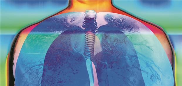 Wenn in den Lungenarterien zu viel Druck herrscht, ist das bei EMAH-Patienten ein ungünstiges Zeichen. Peter Maltz/dieKLEINERT.de/picture-alliance
